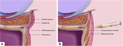 Application of infraorbital rim augmentation with pocket fat filling to correct tear trough deformity